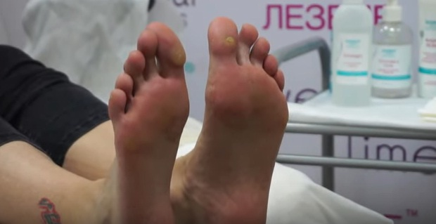 DOMIX Средство локальное для удаления натоптышей и уплотнений кожи стоп Жидкое лезвие / DGP 1000 мл, фото 2